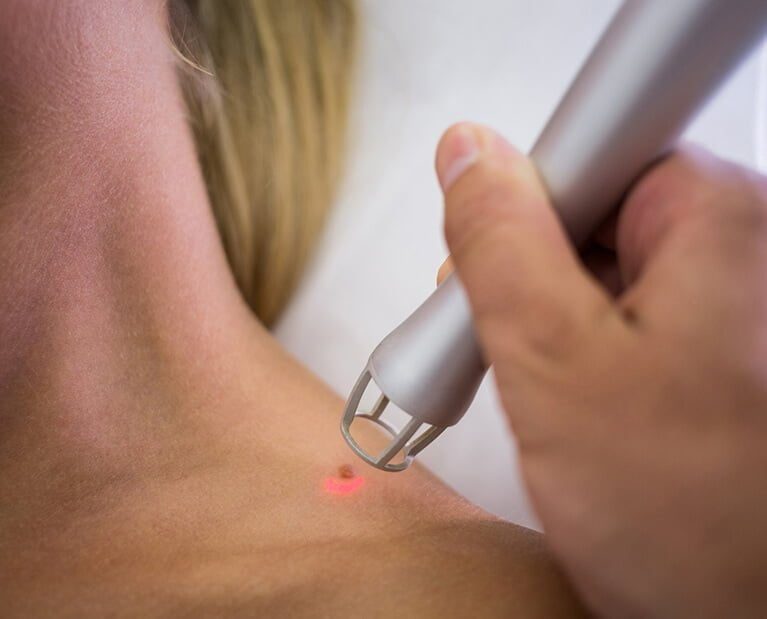 mole removal(1)