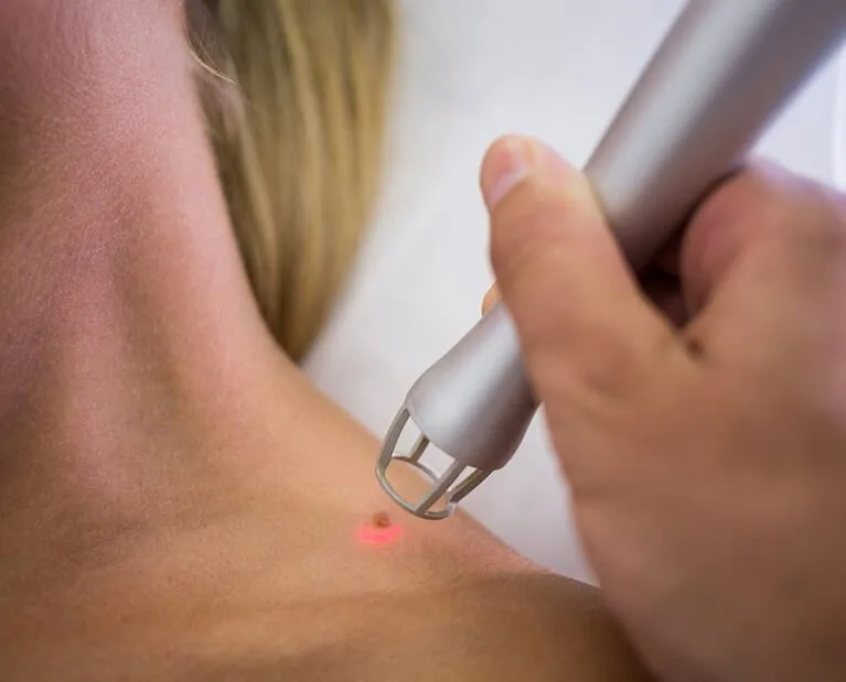 mole removal(1)